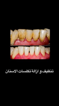 تنظيف الأسنان • إزالة التكلسات • مجاني