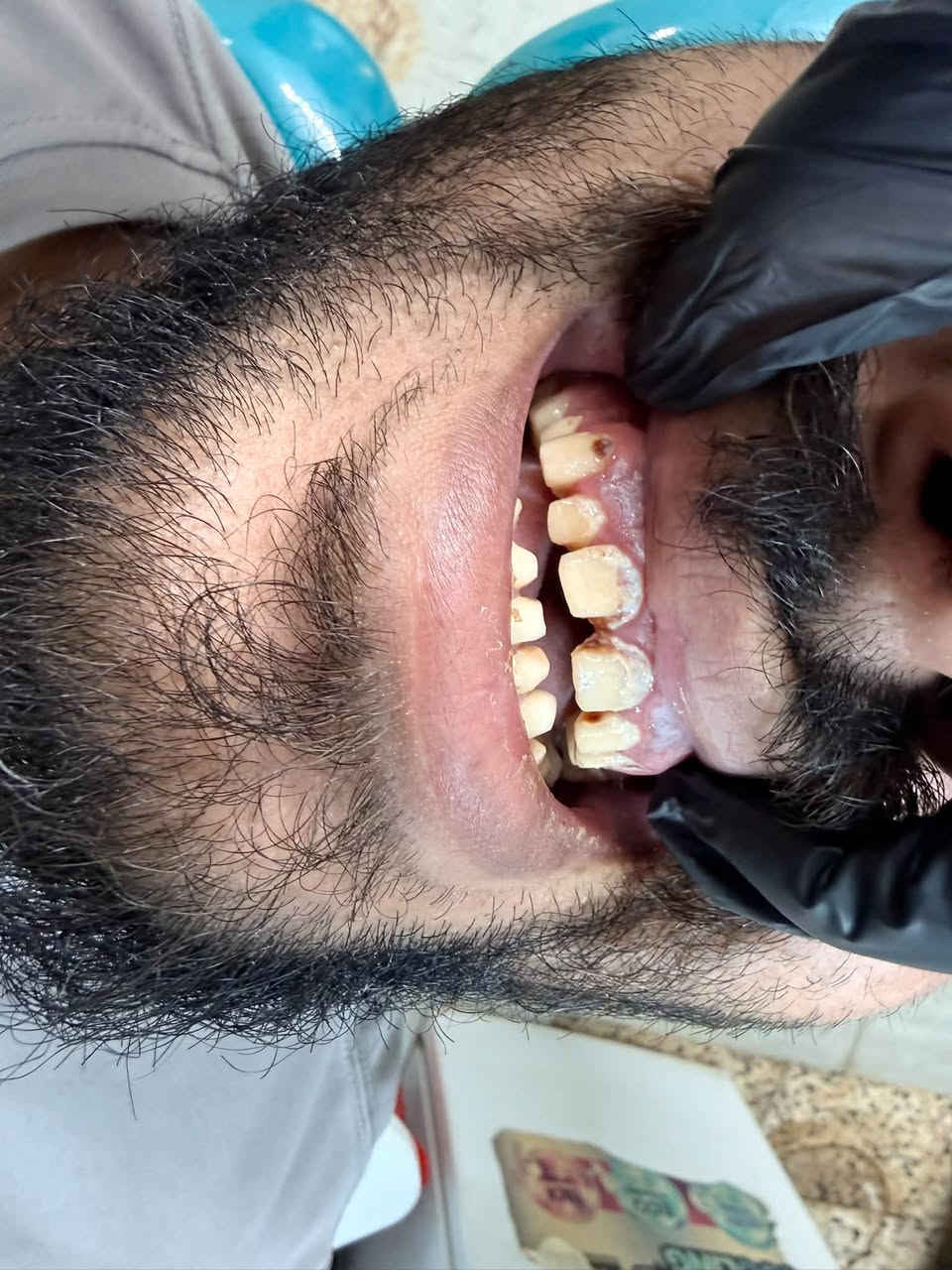 تعلن عيادة بلاتين لطب الأسنان و التجميل عن خصومات بنسبه ٤٠ ٪؜ لفترة محدوده 🎉🎉
تخفيضات على الفلر و البوتوكس و ابر النضاره 

تخفيضات على كافه انواع الابتسامات و الزراعه و الحشوات و تنظيف الاسنان

للاستفسار و الحجز على الرقم 

 ***********
***********

العنوان : شارع شهداء البياع العام -مقابل مطعم دجاج العبيدي- مجمع بلاتين التخصصي
