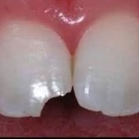 حشوة تجميلية • تسوس بين الأسنان • مجاني