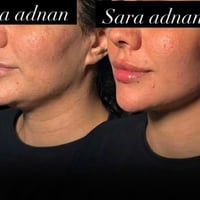 تحديد فك • رسم شفة • د. ساره عدنان