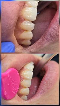حشوة ضوئية • تجميل أسنان • الاسكندريه