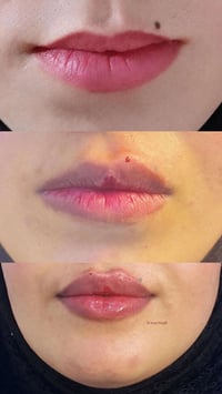 فلر الشفة • عروسات • د نور رياض