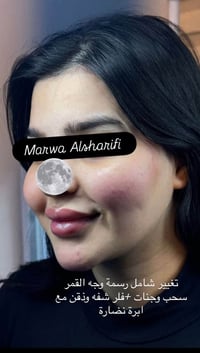 تغيير شامل بالفلر رسمة وجه القمر من ايد خبيرة التجميل الغير جراحي Marw...
