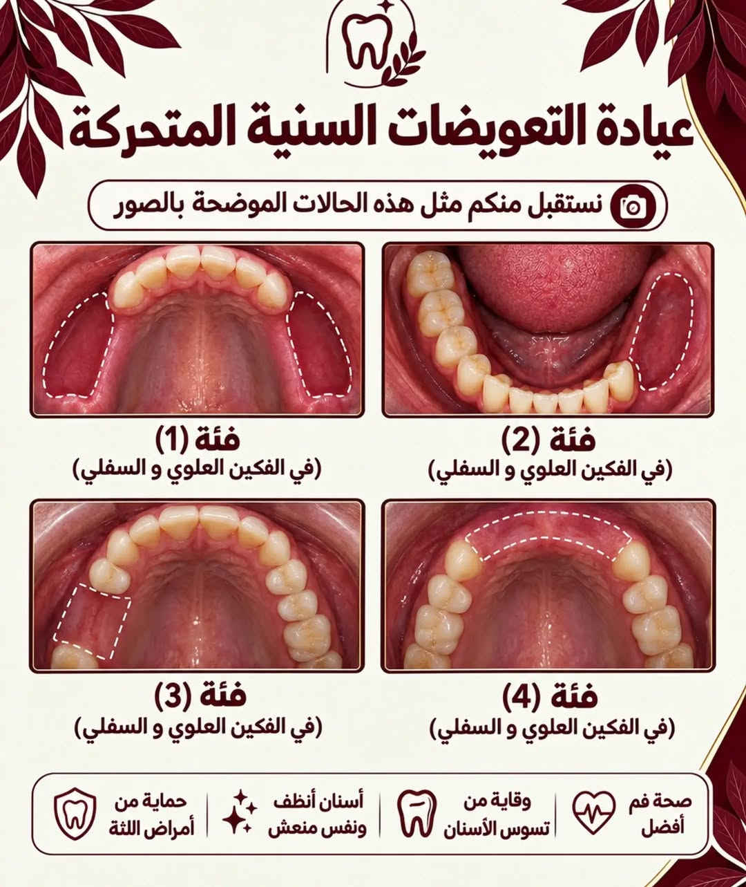 قال تعالى 
﴿وَمَا تَوْفِيقِي إِلَّا بِاللَّهِ ۚ عَلَيْهِ تَوَكَّلْتُ وَإِلَيْهِ أُنِيبُ﴾

بعد سنوات من الدراسة والتعلم النظري والعملي، أبدأ مرحلة جديدة ومهمة في مسيرتي كطالب طب أسنان: العيادات السريرية.
خلال هذه المرحلة سأشارككم جانبًا من الحالات والخدمات التي نستقبلها في العيادات السريرية، بالإضافة إلى معلومات ونصائح بسيطة تساعدكم على الاهتمام بصحة الفم والأسنان.
📍 جامعة العين العراقية – المستشفى التعليمي لكلية طب الأسنان
إذا كنت بحاجة إلى إحدى الخدمات التي نعلن عنها، يمكنك التواصل معي عبر الرسائل لمعرفة التفاصيل ومواعيد الاستقبال.

#الناصرية #طب_اسنان #العراق #اكسبلور

نص مكتوب في الصور:
- د. الحسن علي العبودي طالب طب أسنان تنظيف الأسنان من التصبغات و إزالة التكلسات معالجة الأسنان بالحشوات الضوئية (التجميلية) قلع الأسنان والجذور التالفة تعويض الأسنان المفقوده بطقم جزئي متحرك الموقع شارع النيل _ حي الشهداء _ جامعة العين العراقية _ المستشفى التعليمي لكلية طب الأسنان ملاحظة وذلك بأشراف نخبة من الأطباء المختصين مع إستخدام أحدث الأجهزة و المواد لضمان أفضل النتائج و العلاج مجاني بالكامل alhassanalii19 *********** ***********
- عيادة تنظيف وإزالة تكلسات الاسنان نستقبل منكم مثل هاي الحالات الموضحه بالصور حماية من أمراض اللثة أسنان أنظف ونفس منعش وقاية من تسوس الأسنان صحة فم أفضل الي عنده مثل هاي الحالات او يعرف شخص آخر محتاج تنظيف فخلي يتواصل معنا
- عيادة قلع الأسنان نستقبل منكم مثل هاي الحالات الموضحة بالصور سن متسوس سن مكسور سن متآكل بشدة سن متحرك تسوس عميق الأسنان المسببة للزحام سن مصاب بالعدوى تسوس كبير سن غير قابل للترميم فشل علاج العصب سن لبني متبقي سن تالف لا يمكن ترميمه حماية من أمراض اللثة أسنان أنظف ونفس منعش وقاية من تسوس الأسنان صحة فم أفضل
- عيادة الحشوات التجميلية (الضوئية)
- نستقبل منكم مثل هذه الحالات الموضحة بالصور
- 1
- فئة (1)
- 2
- فئة (2)
- 3
- فئة (3)
- 4
- فئة (4)
- 5
- فئة (5)
- عيادة التعويضات السنية المتحركة
- (في الفكين العلوي و السفلي)
- صحة فم أفضل
- وقاية من تسوس الأسنان
- أسنان أنظف ونفس منعش
- حماية من أمراض اللثة
