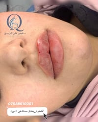 فلر شفة • ١ سيسي • الشطرة