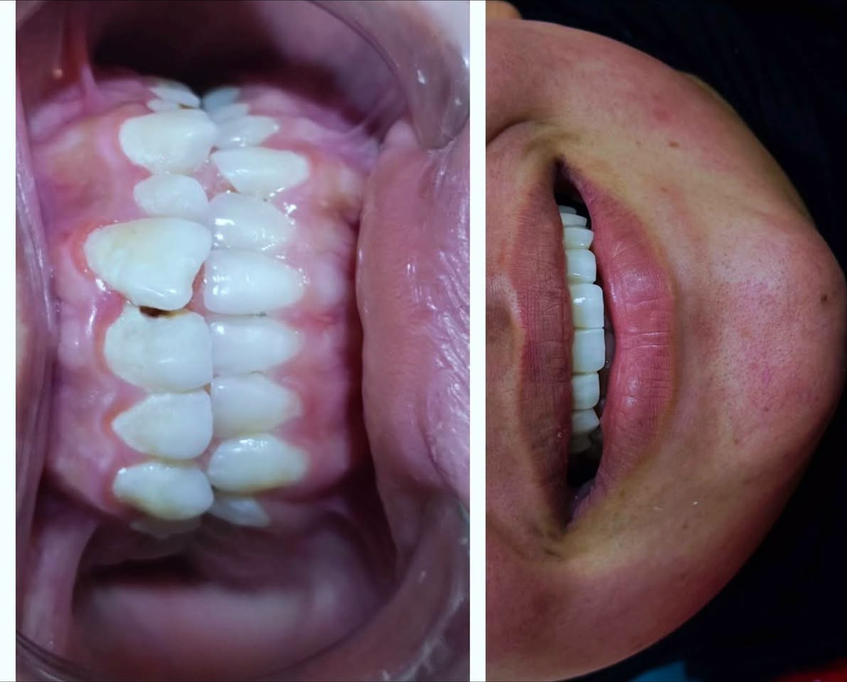 #عيادة طب الاسنان 🦷
#الدكتور فائق أحمد حمود 🩺🥼
#بكالوريوس طب وجراحة الفم والأسنان B.D.S
#يتواجد في العيادة من السبت إلى الخميس مساء 
☎️☎️0️⃣7️⃣8️⃣1️⃣9️⃣1️⃣8️⃣1️⃣8️⃣3️⃣5️⃣♻️📶
♦️يتوفر زراعة الاسنان. ♦️تقويم الاسنان ♦️تركيب الاسنان الثابته والمتحركه. ♦️قلع الاسنان. ♦️تنظيف وتبييض الاسنان بالليزر.♦️ حشوات تجميليه. ♦️حشوات بلاتين. ♦️حشوات الجذور 
#العنوان. الحويجه. شارع الاطباء. الفرع الثاني.
 #مجمع الكندي  الطبي.🏥 
للحجز والاستفسار 
الاتصال على الرقم 📲
***********

نص مكتوب في الصور:
- قبل بعد
- تقويم الاسنان قبل بعد