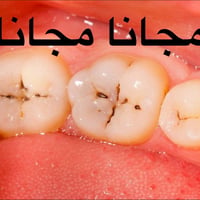 علاج تسوس • مجاني • النجف
