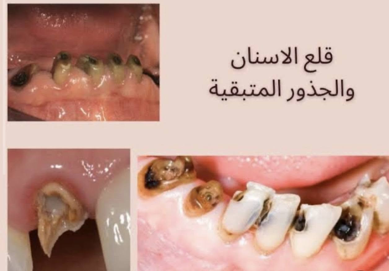 قلع أسنان • علاج مجاني • كربلاء عمود١١١١