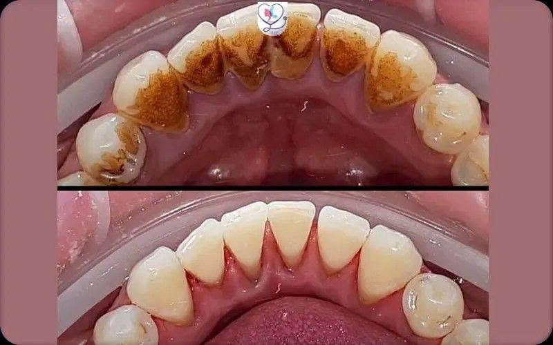 تنظيف أسنان • تكلسات • مجاني
