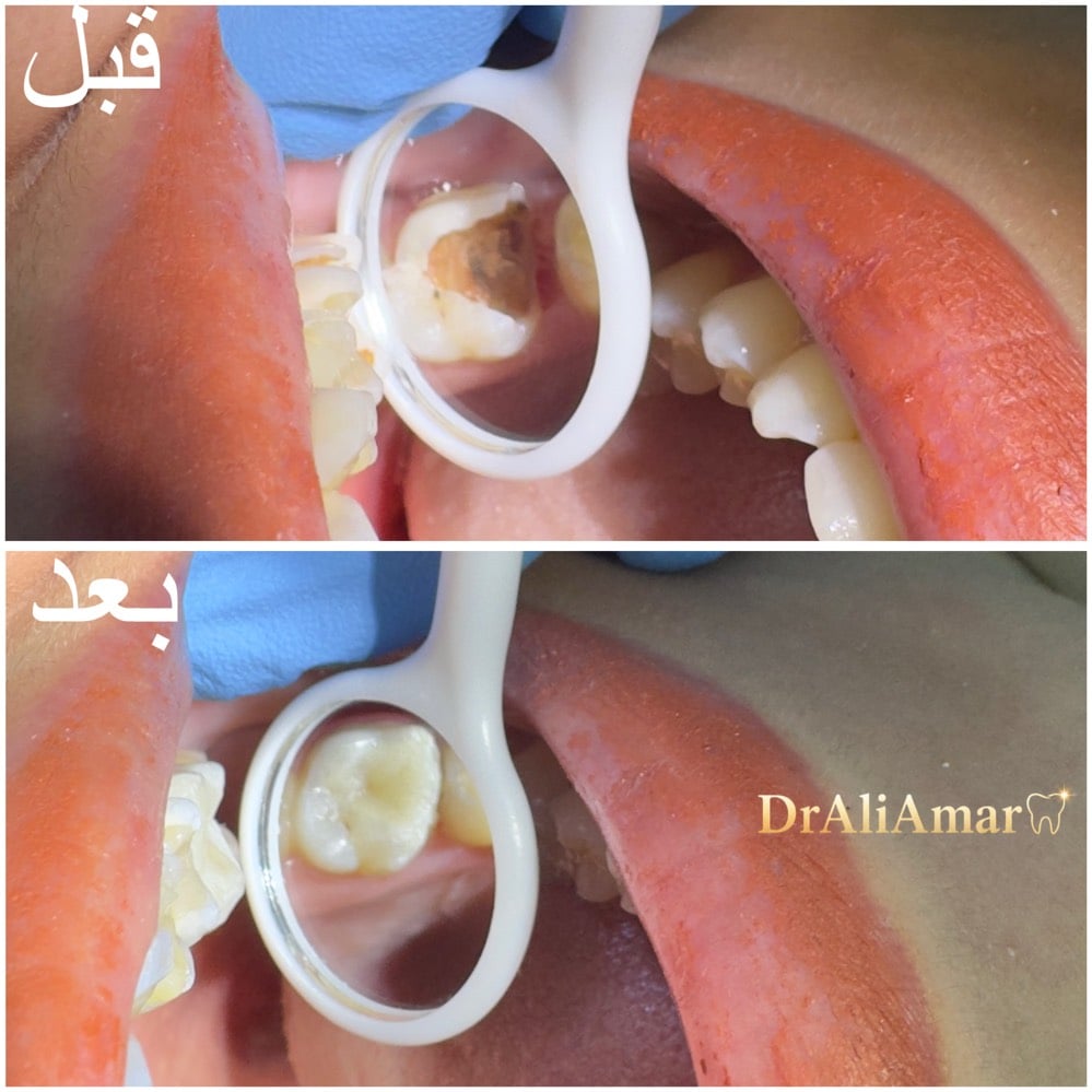 التنظيف لأول جلسة مجاني 🦷🤍
والذي يميزنا عن باقي العيادات نستقبل حالات الطوارئ لمدة 24 ساعة 
ورقم الطوارئ وللحجز والاستفسار : ***********
الموقع📍:الحسينية_الراشدية / مقابل الحاج الحسن ومجاور لمصور الزهور
#dentist #doctor #الحسينية #مطعم_الامير #طب_اسنان