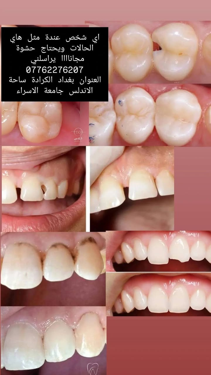 قلع جذور مجاني • حشوة مجانية • بغداد الكرادة