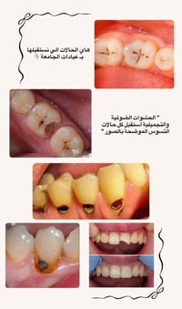 علاج مجاني • حشوات ضوئية • كلية طب الاسنان