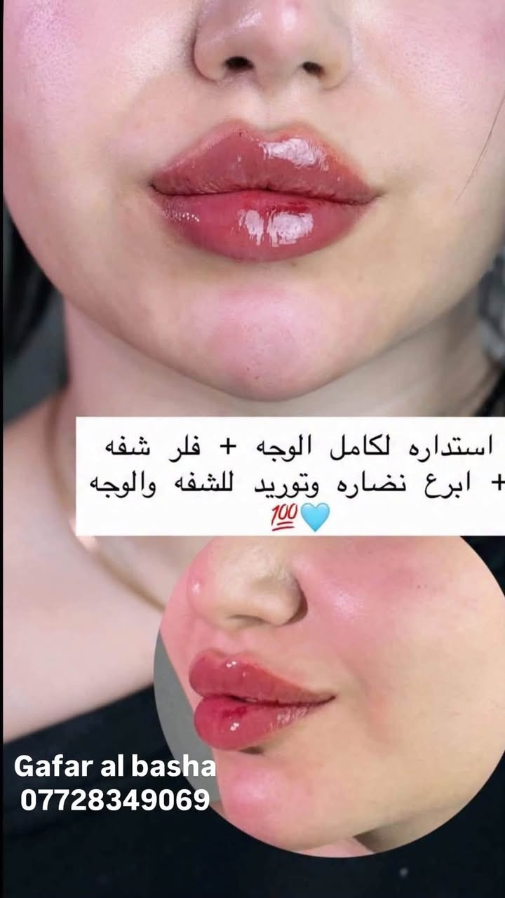 عروض قسم العيادة💉🔥
لشهر 9 فقط😍
قسم الفلر : 👇🏻
🌷فلر امريكي ٧٥ الف فقط
🌷فلر كوري  ٧٥ الف
🌷فلر سوفي ديرم الماني ٨٠ الف 
🌷فلر جوفيديرم الفرنسي ٨٠ الف
🌷فلر سويسري٩٠ الف
🌹 فيلر ايطالي 100
🌸🌸🌸🌸

عرض التغيير الشامل ( شفة + وجنات + تكساس ) 350 الف فقط
Vip اب 600 الف 
🌸🌸🌸🌸

🌷ابره العروسه ١٢٥ الف بدل ال١٧٥
🌷بوتوكس كامل ١٠٠  الف بدل ال١٥٠ الف
🌷بوتوكس عدد شخصين اب١٥٠ الف
🌸🌸🌸🌸

قسم البشرة :
🌷ميزو تصبغات  50 الف
🌷ميزو هالات 50 الف
🌷هايدروفيشال  25 الف
🌷 ميزو تبييض 50 الف 
🌷علاج التصبغات البشرة 50 الف وب 75 و100 حسب النوع
🌷تنظيف البشرة + ميزو تبييض مع بلازما ٧٥ الف
🌷تنظيف البشرة الملكي ٥٠ الف الف
🌷بلازما + خلايا جذعية ٤٠ الف

 📆ايام الدوام : طيلة ايام الاسبوع
⏰وقت دوام الدكتور و الدكتورة: ‎من ١٢ مساءا  - الى ال١٠ مساءا  
📲للحجز والاستفسار 
***********💎

العنوان/ العماره مغربه

#تجميل #جمال #مكياج #تسريحات #صالون #مناكير #ميك_اب #صبغات #تساريح #ازياء #نقش #عدسات #فساتين_عرايس #حنه #ستايل #رشاقه #فاشن #عروس #موضة #لیزر #كونتور #مشغل #فساتين_سهرة #اناقه #فساتين_زفاف #0
