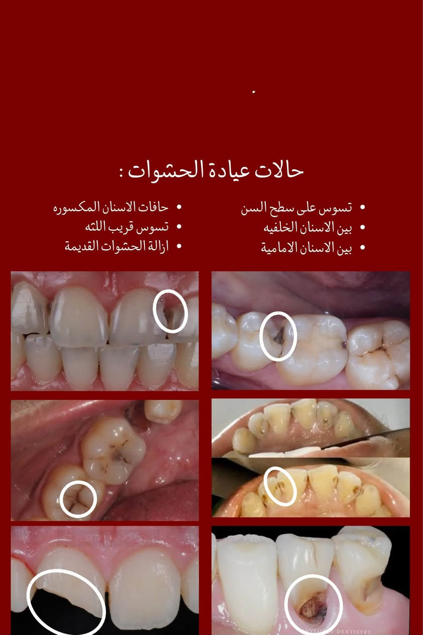 السلام عليكم
نعلن عن توفر خدمات العلاج المجاني للأسنان بشكل كامل 
تحت اشراف اطباء مختصيين 
بحالة عدكم 
(قلع ، تسوسات ، تعويض اسنان بطقم متحرك، تنظيف اسنان) والحالات الي موجوده بلصور وتحبون تعالجوها   بشكل مجاني تكدرون تتواصلون ويايه ونرتب موعد يناسبكم على الرقم  ***********  
موقع العيادات : الدوره _ شارع المصافي_ كلية دجله الجامعه

نص مكتوب في الصور:
- الدكتورة رغد عامر طالبة طب اسنان تحت التدريب من خدماتنا علاج تسوس الاسنان باستخدام الحشوات الضوئيه تعويضات صناعية للأسنان المفقوده تنظيف الاسنان وتلميع الاسنان من التكلسات قلع الاسنان وبقايا الجذورالتالفه احجز موعدك الأن الدورة_ شارع المصافي_ جامعة دجله *********** @msqai علماً ان العلاج مجاني و تحت اشراف اطباء مختصییبن
- حالات عيادة الجراحة : بقايا جذور الاسنان التالفه الاسنان المتحركه الاسنان التالفه
- حالات عيادة الحشوات :
- • تسوس على سطح السن
- • بين الاسنان الخلفيه
- • بين الاسنان الامامية
- • حافات الاسنان المكسوره
- • تسوس قريب اللته
- • ازالة الحشوات القديمة
- حالات عيادة التنظيف : التكلسات التصبغات بسبب التدخين والمشروبات اي احد يحب يسوي تنظيف يكدر يتواصل ويايه ( اللي موضح بلصوره كذلك )
- حالات عيادة التعويض : تعويض الاسنان المفقوده بطقم جزئي متحرك مثل الحالات الموضحه بلصور