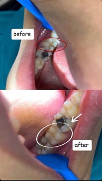 طالبة طب أسنان • عيادات جامعة البيان • علاج مجاني