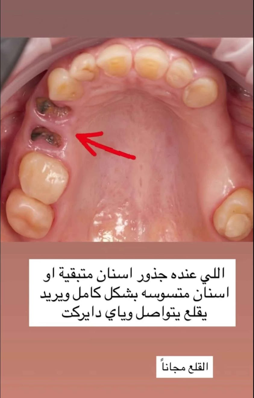 تكدر تحجز موعدك داخل عياداتنا التعليمية لتلقي العلاج بشكل مجاني
.

لحجز موعدك او الاستفسار تكدر تتواصل ويانه على :

.

📞:***********

Telegram: @f23ot

Instagram: @f22ot 

.

العنوان : البصرة _الجنينه _ شارع التجاري _ جامعة المعقل الاهلية Singapore

نص مكتوب في الصور:
- د. فاطمه الأحمد قلع الاسنان والجذور المتهالكة حشوات تجميلية تركيب اطقم متحركة تنظيف اسنان وازالة التكلسات جلسة فلورايد للاطفال لحماية الاسنان من التسوس @f22ot *********** البصرة_الجنينه_شارع التجاري_جامعة المعقل الاهلية
- اللي عنده جذور اسنان متبقية او اسنان متسوسه بشكل كامل ويريد يقلع يتواصل وياي دايركت القلع مجاناً
- رجعت العيادات ورجع توفر عدنا ازالة تكلسات وتنظيف للاسنان مجاني وتحت اشراف دكاترة مختصين للحجز مراسلة دايركت
- dr.fatima alahmed
- (Bring it on 'cause there's gon' be shit tonight) At the starting of the week At summit talks, you'll hear them sp drfatima alahmed