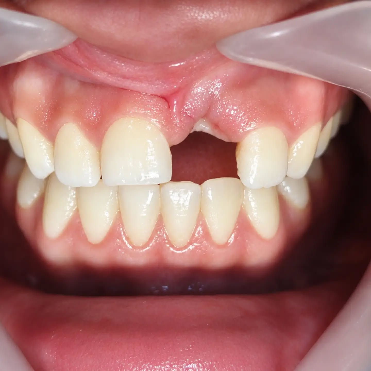 🦷✨ حالة تركيب أسنان ✨🦷

استعادة الابتسامة لا تعني فقط تعويض الأسنان المفقودة، بل تعني أيضًا استعادة الشكل الجمالي والتناسق والوظيفة. 🤍

في هذه الحالة تم العمل على تركيب الأسنان الأمامية مع الاهتمام بالتناسق، الشكل الطبيعي، والانسجام مع الأسنان واللثة المحيطة.

✨ نتيجة تجمع بين الجمال والطبيعية
🦷 لأن كل ابتسامة تستحق أن تكون أجمل.
                   عيادة لانــا لطب وتجميل الأسنان
      عفـــك_ مجاور صيدلية بشرى رحمن حيذور
                  مقابل محلات الذهب
📞 للحجز والاستفسار: ***********
