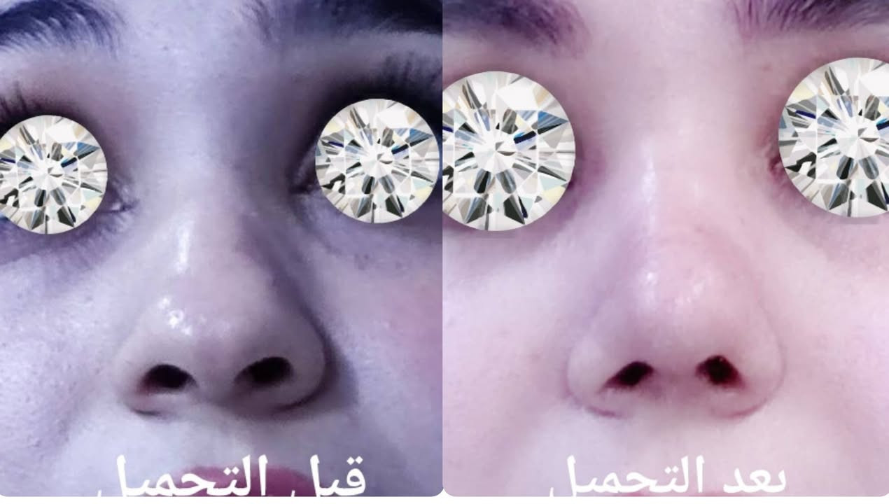 تجميل الانف الغضروفي المنتفخ.. Bulbous Rhinoplasty
***********

نص مكتوب في الصور:
- بعد التجميل قبل التجميل
- قبل التجميل
- بعد التجميل
- قبل التحميل بعد التحميل