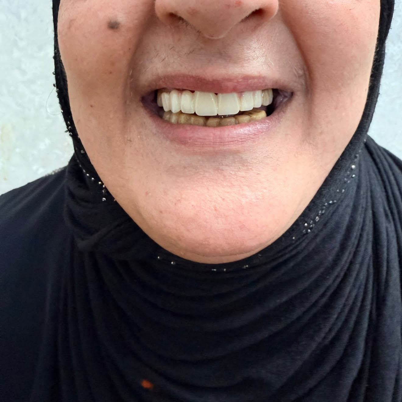 تعلن عيادة بلاتين لطب الأسنان و التجميل عن خصومات بنسبه ٤٠ ٪؜ لفترة محدوده 🎉🎉
تخفيضات على الفلر و البوتوكس و ابر النضاره 

تخفيضات على كافه انواع الابتسامات و الزراعه و الحشوات و تنظيف الاسنان

للاستفسار و الحجز على الرقم 

 ***********
***********

العنوان : شارع شهداء البياع العام -مقابل مطعم دجاج العبيدي- مجمع بلاتين التخصصي

