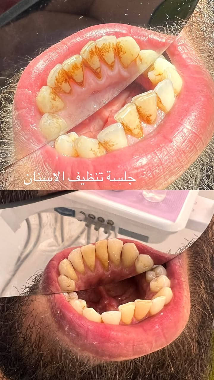 عيادات جامعة المعارف • طقم اسنان متحرك • تنظيف اسنان
