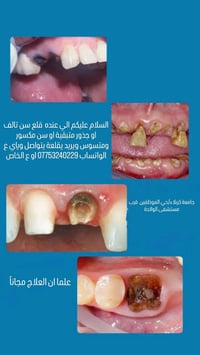 قلع سن • مجاناً • جامعة كربلاء