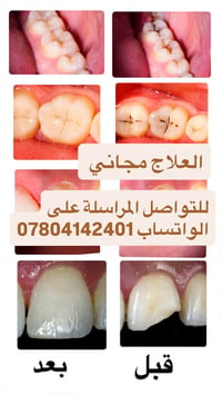 علاج مجاني • عيادات الفراهيدي • تنظيف أسنان