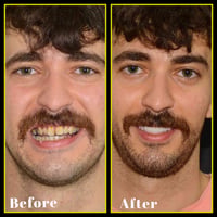 تجميل أسنان • ابتسامة جديدة • أربيل هفلان