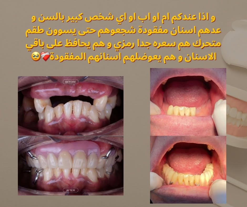 السلام علیکم
اي احد عنده تسوس او تصبغات او تكلسات او جذر متبقي او سن تالف او اسنان
بفقودة يريد يعوضهن يتواصل ويانا

[***********](tel:***********)
تليجرام 👈 Ayaa3_14@ 

موقعنا: جامعة الكوفة - قرب كلية الفقه

نص مكتوب في الصور:
- شكل اسنانكم ما عاجبكم و تريدون تسوولهن تنظيف مجاني؟ تعالوا لعيادات جامعة الكوفة
- و اذا عندكم ام او اب او اي شخص كبير بالسن و عدهم اسنان مفقودة شجعوهم حتى يسوون طقم متحرك هم سعره جدا رمزي و هم يحافظ على باقي الاسنان و هم يعوضهم اسنانهم المفقودة🥺💕
- BEFORE
- AFTER
- لا تتركو التسوس يوصل مرحلة منكدر نعالجة الا بحشوة جذر! ف عالجوه بحشوة ضوئية 👀✨
- و اي جذر متبقي او سن تالف لا تتركوه لازم نسويله قلع لان راح يجمع بكتيريا و يسوي التهاب و يضعف العظم بالمنطقة 😅
- و غيرها من الحالات اللي نعاجلها بعياداتنا ✨️🫶✨️ حافظوا على ابتساماتكم الحلوة.. خصوصا انو نقدم لكم بعياداتنا بجامعة الكوفة علاج مجاني و تحت اشراف دكاترة اختصاص 🫶