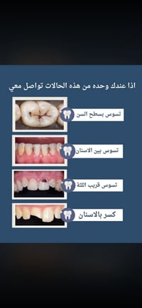 علاج اسنان • مجانا • تسوس وكسر
