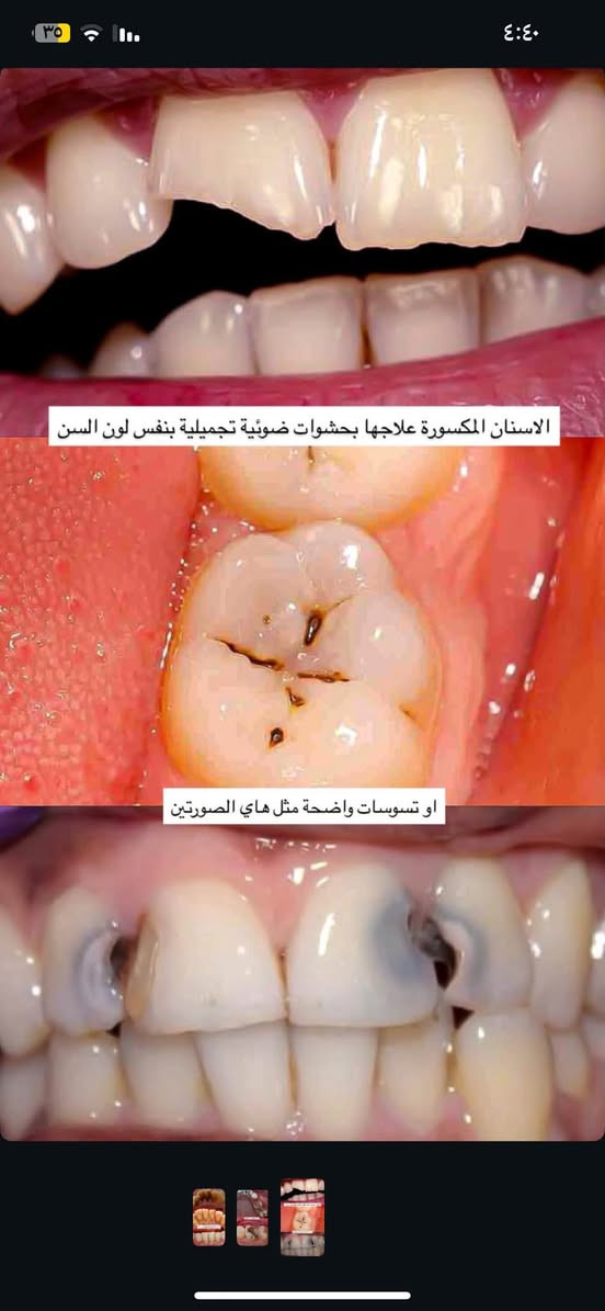 علاج مجاني • تنظيف وإزالة الجير • حشوات تجميلية