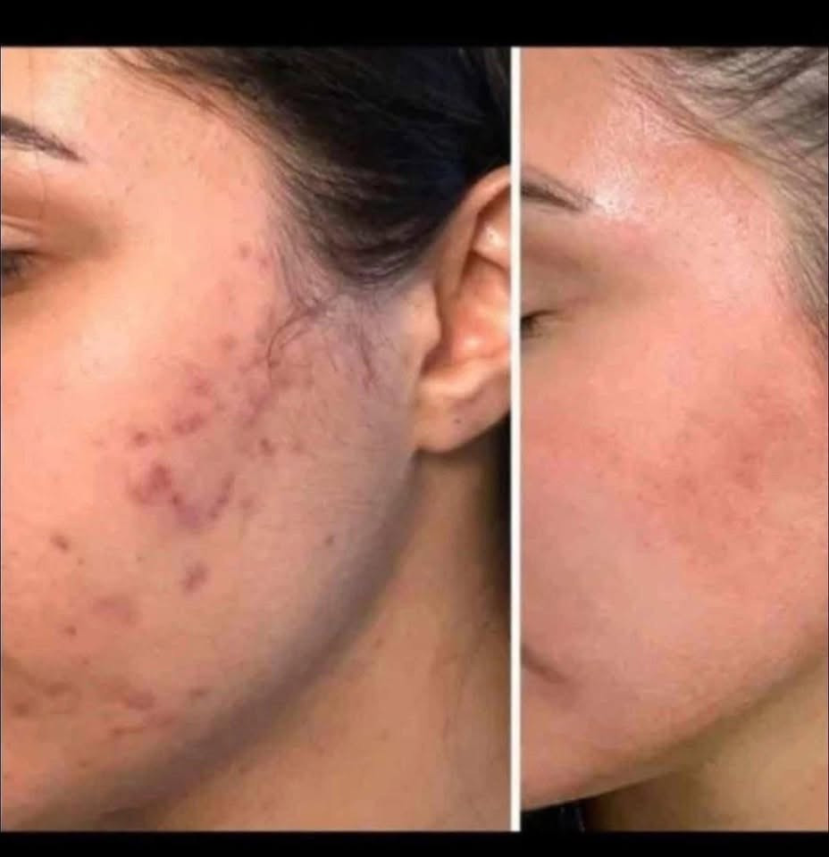 تۆش بەدەست کێشەکانی پێستەوە دەناڵێنی نازانی چی لێبکەیت و بەچی چارەسەری بکەیت🤔
کرێمێکت دەوێت بەگرەنتی👌 پارەگەڕانەوە ئەگەر سوودی نەبوو لەماوەی تەنها 🔺١٥ڕۆژدا
🟡سێتی کرێمی ئەمەریکی ئەڵلماس کەخاوەنی کوالێتی کۆنترۆڵە ☑️
ئەوەی ئەم کرێمەی بەکارهێناوە بۆهەمیشەیی ماڵئاوای لەتەواوی کێشەکانی ڕوخساری کردوە و دەوروبەری داوای ئەم کرێمەیان لێکردوە بەهۆی سوودو گۆڕانکاریە زۆرەکەیەوە 👍
ئەم کرێمە چارەسەری تەواوی ئەم کێشانەی ڕوخسارت بۆدەکات بەگرەنتیەوە 
🔺لابردنی زیپکەو شوێنەواری زیپکە
🔺لابردنیی پەڵەی سەرپێست و ژێرپێست
🔺لابردنی ڕەشی ژێرچاوو یەک ڕەنگ کردنی روخسار بەتەواوی
🔺لابردنی سوتاوی بەرخۆرو نەرم کردن و سافکردنی دەماوجاوو بەگشتی یەک ڕەنگردنی 
🟡کارتی گرەنتی و زەمانی بەکارهێنانی لەگەڵدایە سوودی تەواوت وەرنەگرت قەرەبوی تەواو دەکرێیتەوە 
بۆداواکردن و زانیاری زیاتر پەیوەندی بەم ژمارەیەوەبکەن
🚕گەیاندنمان بەردەستە 
📞***********

نص مكتوب في الصور:
- پاش به کار هینان پیش به کار هینان سروشتی ئه لماس
- BEFORE AFTER