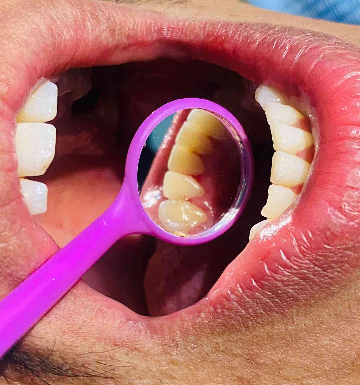العلاج مجاناً • حشوات تجميلية • قلع جذور