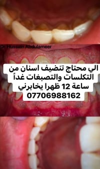 عيادات جامعه كربلاء • تنظيف اسنان • د حسين عبد الامير