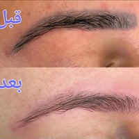 إزالة تاتو حاجب • بيكوشور • مركز الهدى