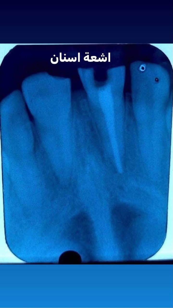 اللي يريد يحجز يتصل او يدز عالخاص
عيادة طب الاسنان 
تقويم الاسنان ،، زراعة الاسنان ،، حشوات تجميلية
تركيب الاسنان (سيراميك و زارگون)،، حشوات جذور ،، قلع،، حشوات مؤقتة ودائمية ،، تنظيف وتلميع الاسنان ،، تبييض الاسنان بالليزر 
متواجدين طيلة أيام الاسبوع 
للحجز والاستفسار ع الخاص او ع الرقم 
*********** واتساب 
العنوان .. الامين الثانية شارع البنازيخانة يم السوگ 
قریب ع افران السلام واسواق الشارقة مقابل محلات الصبيحاوي
مجمع دكتورة رجاء محمد نصيري
