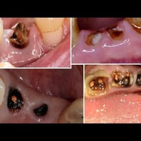 عيادات بلاد الرافدين • قلع اسنان مجاني • حشوات مجانية