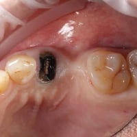 علاج مجاني وبإشراف أطباء اختصاص! 🦷✨ نستقبلكم بعيادات جامعة آشور ونقدم ...