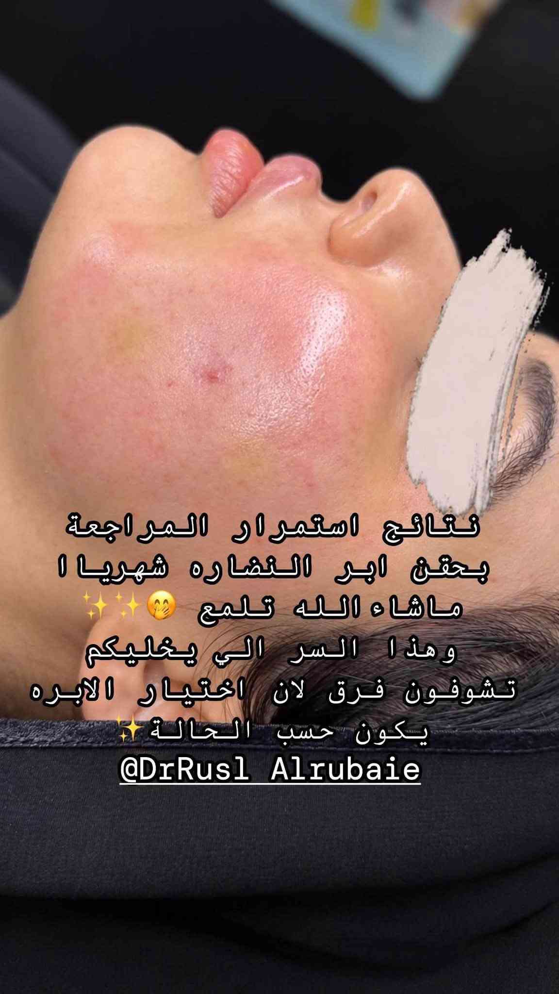 ابر النضارة • فلر شفايف • المسيب