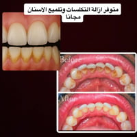 ازالة التكلسات • تلميع الاسنان • عيادات الجامعة