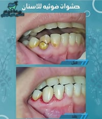 ✌🏻مميزون 😇💪🏻  ✨ حشوات ضوئيه دائميه 🦷 واعاده تفاصيل            الاسنان ...