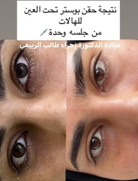 فلر • ذقن وشفة • عيادة زهراء