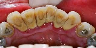 السلام عليكم ورحمه الله وبركاته
الي عندة هاي الحالات يتواصل ويانة
‏‪+9647765563607‬‏
dr.hiba.dentist
