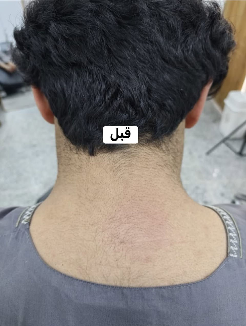 🔥 النتيجة تحچي عن نفسها!
📸 قبل وبعد جلسات إزالة الشعر بالليزر للرقبة.

بشرة أنعم ✨
شعر أقل 🌿
وثقة أكبر 🤍

💯 في بارين بيوتي… نتابع النتيجة وياك ونضمن رضاك وفق شروط المركز.

📍 ناحية القيارة – شارع الأطباء – مجمع ابن سينا الطبي التخصصي

📲 احجز جلستك الآن ***********
