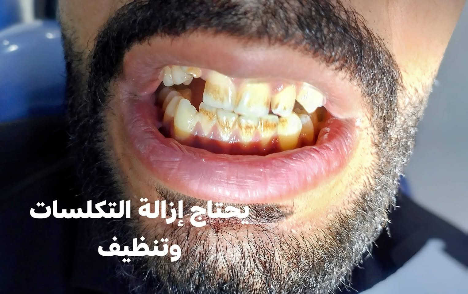 🦷 عندك حالة أسنان وتدور على علاج بسعر رمزي؟
لفترة محدودة أستقبل حالات للعمل عليها في عيادات جامعة النور التخصصية لطب الأسنان 🤍
الحالات المتوفرة حاليًا:
🦷 قلع الأسنان — 3,000 د.ع
تنظيف الأسنان — 4,000 د.ع
🦷 حشوات ضوئية — 5,000 د.ع

وعندي أيضًا حالات أطفال:
• قلع — 2,000 د.ع
• حشوة — 5,000 د.ع
• فلورايد — 2,000 د.ع
 وحالات التعويضات:
• طقم متحرك كامل لفقدان جميع الأسنان
•
أسعار الأطقم تُحدد حسب الحالة ونوع التعويض.
جميع الحالات تتم داخل العيادات التعليمية وتحت إشراف الأطباء.
📩 إذا عندك حالة أو أحد من أهلك يحتاج علاج، دزولي صورة للحالة بالخاص وأوضح لكم إذا الحالة مناسبة والتفاصيل كاملة.
🤍 واللي يعرف شخص محتاج إحدى الحالات، ياريت يدزله المنشور.
📍 جامعة النور – عيادات طب الأسنان

نص مكتوب في الصور:
- فقدان جميع الاسنان نعوضه بطقم متحرك
- Facebook ...tartar, also called dental حفظ مشاركة What is Dental Calculus? | Atlas Dental
- نقوم بإزالة التسوس ونستخدم حشوة ضوئية
- يحتاج إزالة التكلسات وتنظيف