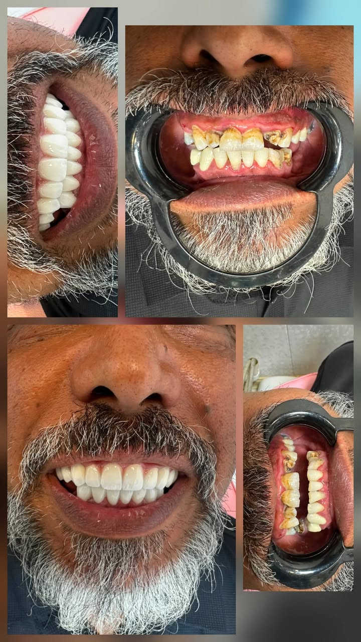 ابتسامة أحلامك وإطلالة أنيقة تبدأ من هنا! ✨🦷💖
يسعدنا في [عيادة الوسامة] استقبالكم وتقديم أرقى الخدمات الطبية والتجميلية بخبرة عالية واهتمام خاص.

​💎 خدمات طب الأسنان:
​تبييض الأسنان بالليزر للحصول على ابتسامة هوليوود ناصعة.
​زراعة وتلبيس الأسنان بأفضل الخامات العالمية.
​تقويم الأسنان وعلاج اللثة.
​العلاج التجميلي والترميمي بدون ألم.

​🌸 خدمات التجميل :
​جلسات النضارة 
ابر (فيلر، بوتوكس).

​أحدث تقنيات شد وتجديد شباب الجلد.
​📍 العنوان: 
[بغداد _ السيدية _ شارع الخيزران بجانب مازن كيتو]
📞 للحجز والاستفسار: 
​***********
​***********
💬 أو راسلونا مباشرة عبر الصفحة لتحديد مواعيدكم.

نص مكتوب في الصور:
- عيادة الوسام
- الدكتور
- محمود سامي الزبيدي
- لطب وتجميل الأسنان
- ***********
- ***********
- السيدية شارع الخيزران مجاور مندي
- بوابة اليمن وقابل قهوة ساو
- ابتسامة جديدة ثقة تدوم في عيادة الوسامة نهتم بكل تفاصيل ابتسامتك لنتائج طبيعية وتدوم طويلاً قبل بعد نتائج طبيعية ومضمونة مواد عالية الجودة وآمنة تكنولوجيا حديثة ودقة في العمل ابتسامة جميلة تغير حياتك للحجز والاستفسار *********** *********** عيادة الوسامة بغداد _ السيدية
- حشوات تجميلية استعادة الجمال الطبيعي لأسنانك قبل بعد تحافظ على صحة الأسنان نتائج فورية وجمالية حشوات آمنة وعالية الجودة مظهر طبيعي يندمج مع الأسنان ابتسامة أجمل .. ثقة تدوم