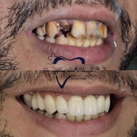تلبيسات زيركون • علاج أسنان • أقساط