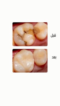 تعلن عيادات جامعة ابن سينا التخصصية لطب الأسنان /المرحله الخامسه |عن ب...