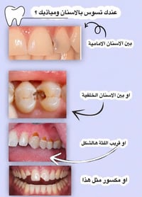 علاج مجاني • قلع أسنان • طقم أسنان كامل