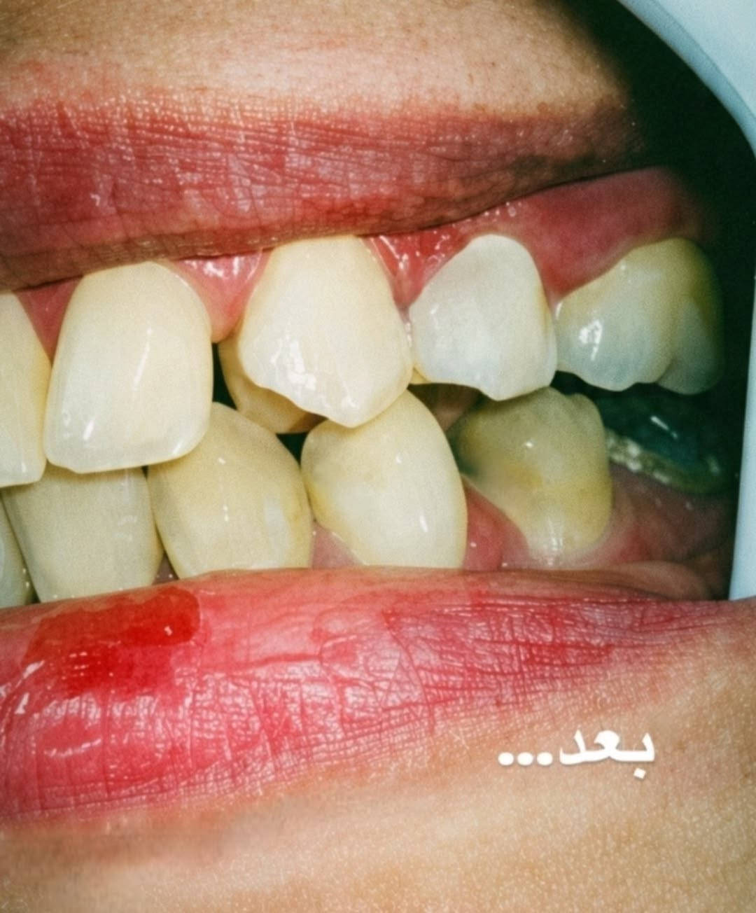 تسوس الأسنان الأمامية مو بس يسبب ألم... يأثر مباشرة على ضحكتك وثقتك بنفسك. 🦷✨
 هاي الحالة المراجعة عدها تسوس بالأسنان الأمامية؛ كان زاعجها لدرجة ماتقدر تبتسم لان التسوس يخرب ابتسامتها 
، تم تنظيف السن بالكامل ورممنا السن  بحشوة ضوئية (تجميلية) بنفس لون السن الطبيعي تماماً، بحيث ترجع الابتسامة طبيعية وبدون أي أثر للترميم✨

ولأن الابتسامة هي جزء أساسي بثقتك بنفسك وهي أول شيء ينتبه له المقابل💫  لا تهمل اي تسوس يخربها ويقلل ثقتك بنفسك

📩 للتواصل وحجز موعد، تقدرون تراسلوني على الخاص
او على الرقم   ***********
📍العيادات التعليمية لطب الاسنان في جامعة المعارف 
كلية طب الاسنان - جامعة المعارف
الدكتورة رانيا ماجد /طالبة طب اسنان مرحلة خامسة
 تقدرون تشوفون شغلي على صفحتي بالإنستغرام ranya_majed28
