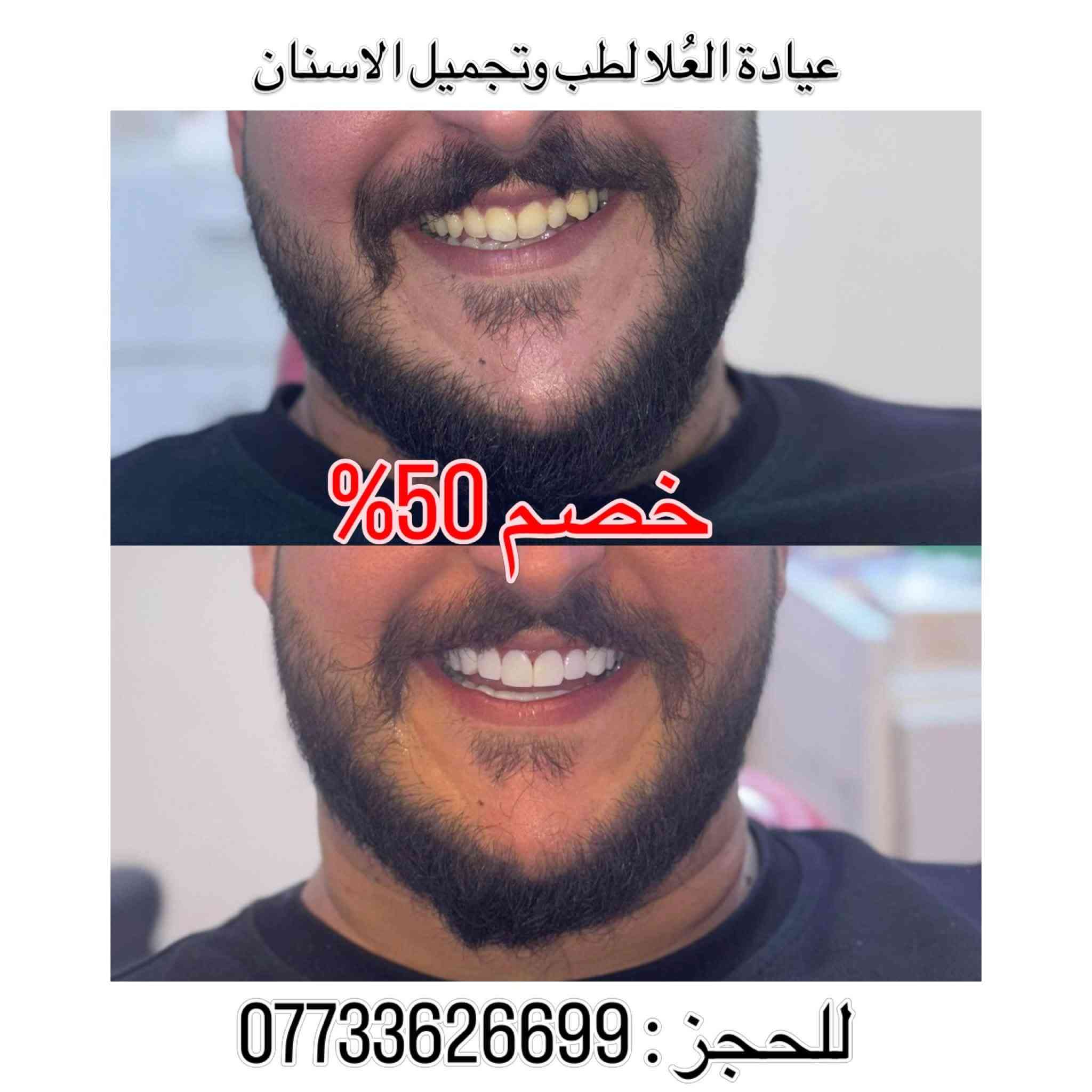 خصم ٥٠٪ • ابتسامة هوليوود • الشرطة الخامسة